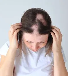 alopecia symptoms